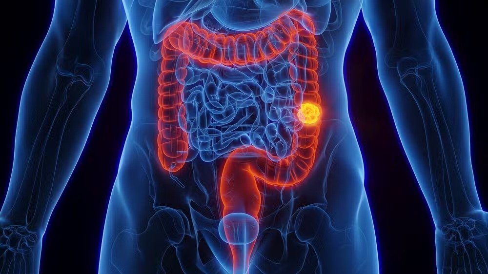 Câncer de intestino: 30% dos casos podem ser evitados com hábitos saudáveis
