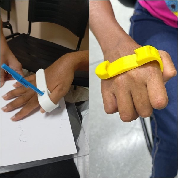 Órteses gratuitas com impressão 3D melhoram vida de pacientes no Piauí