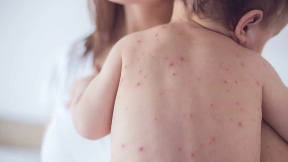 São Paulo registra 14º caso de sarampo em bebê sem vacinação