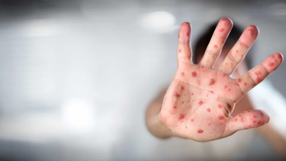 Amnésia imunológica do sarampo e o aumento do risco de infecções