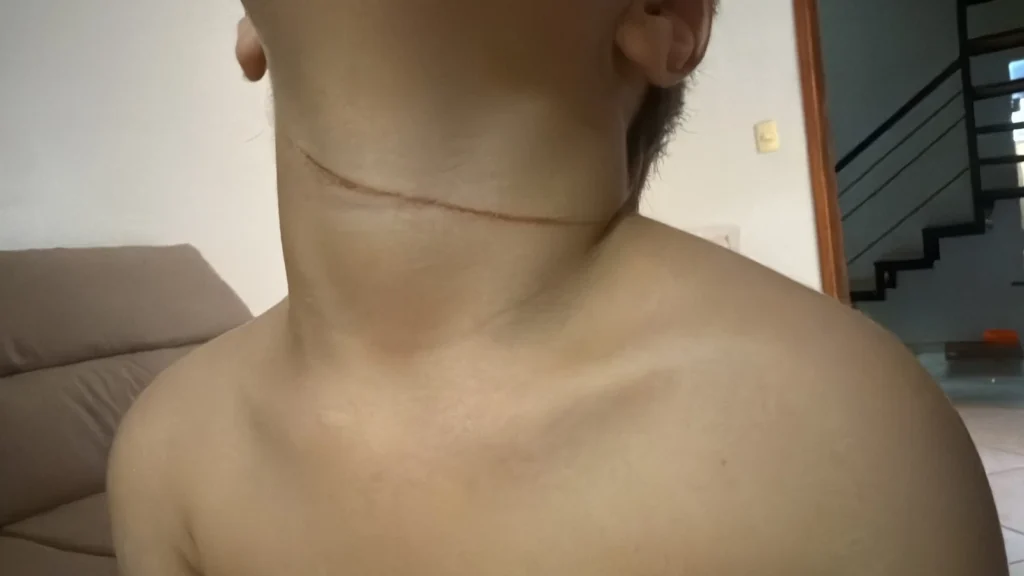 Menino de 4 anos sofre corte no pescoço por linha de pipa com cerol em Parnaíba