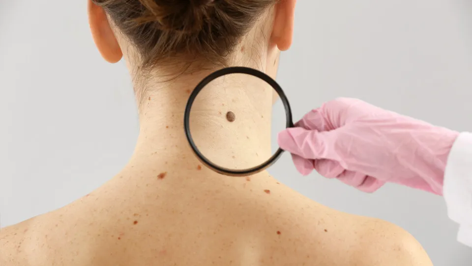 Estudo revela riscos do melanoma fora da pele e destaca importância do diagnóstico precoce