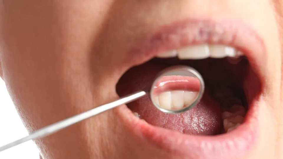 Por que algumas pessoas acumulam mais tártaro dental do que outras?