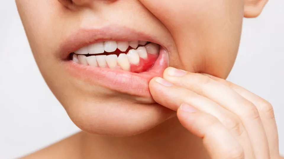 Retração gengival: entenda as causas e como prevenir