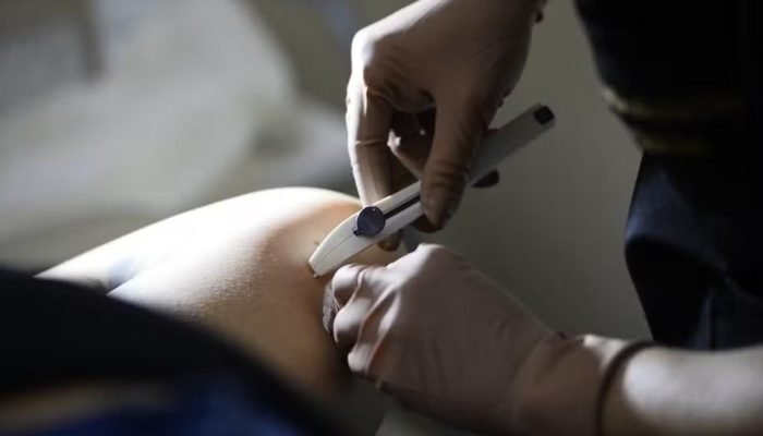 Inserção do Implanon (Foto: Matheus Oliveira/Agência Saúde DF)