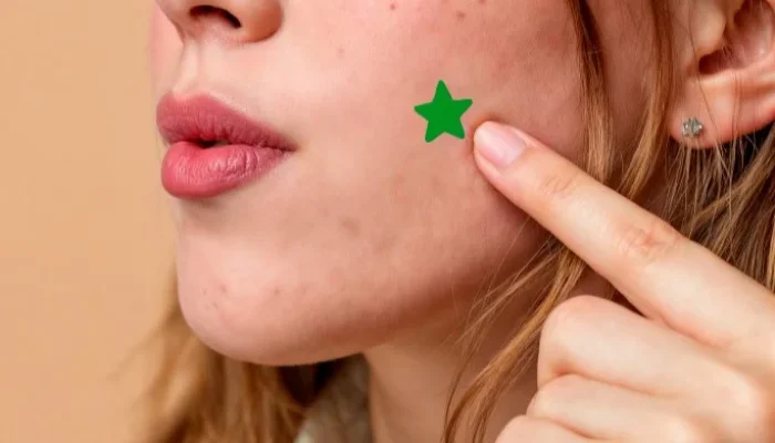 Adesivo para espinha: eficácia e recomendações de uso