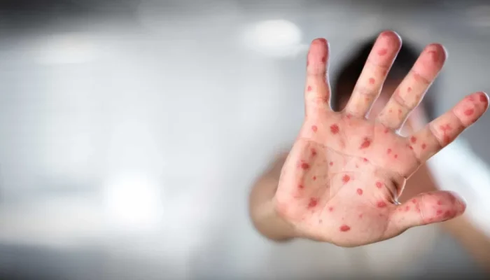 Amnésia imunológica do sarampo e o aumento do risco de infecções