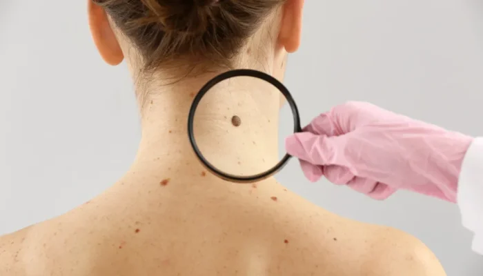 Estudo revela riscos do melanoma fora da pele e destaca importância do diagnóstico precoce
