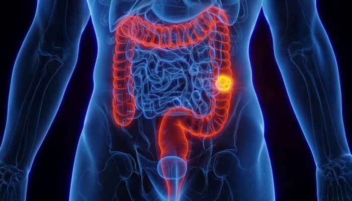 Câncer de intestino: 30% dos casos podem ser evitados com hábitos saudáveis