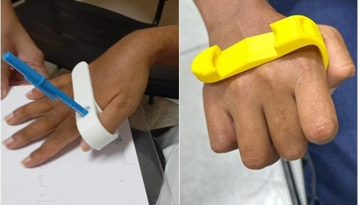 Órteses gratuitas com impressão 3D melhoram vida de pacientes no Piauí