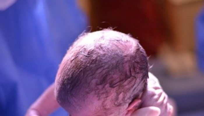 Crescimento das cesáreas em gestações de baixo risco preocupa especialistas