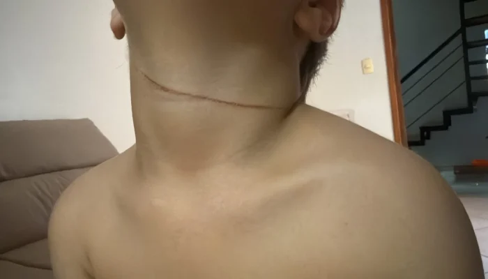 Menino de 4 anos sofre corte no pescoço por linha de pipa com cerol em Parnaíba