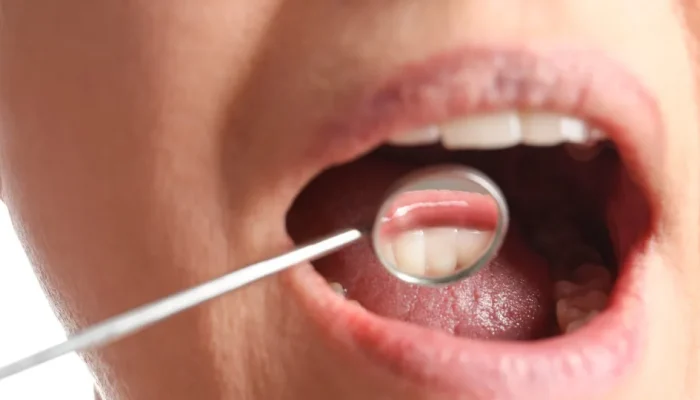 Por que algumas pessoas acumulam mais tártaro dental do que outras?