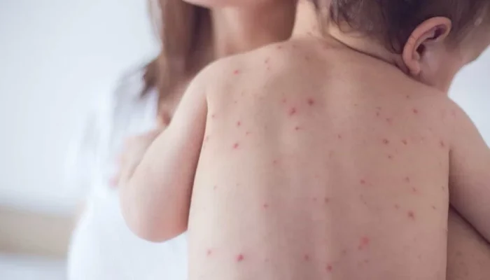 São Paulo registra 14º caso de sarampo em bebê sem vacinação